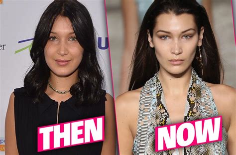 did bella hadid get surgery.